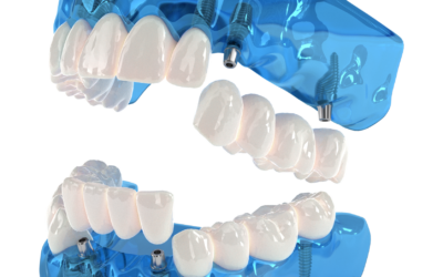 Dentures, All on 4, 3 on 6: Know Your Full Mouth Restoration Options