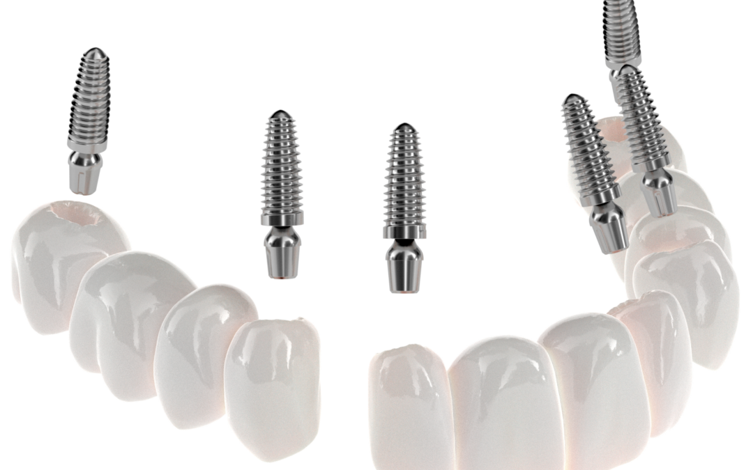 Smile Renewed: The Transformative Power of Replacing Missing Teeth