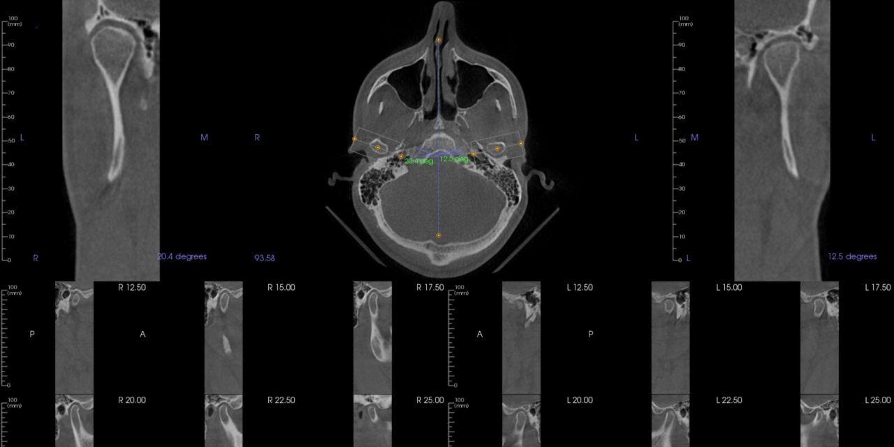 Jaw Head Neck Pain Tmj Pain And Occlusion Reclaim Dentistry