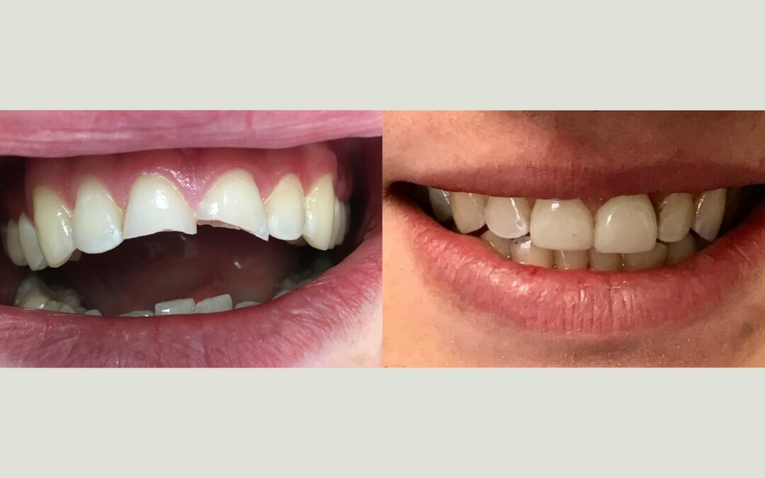 All I Want for Christmas is My Two Front Teeth