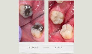 amalgam fillings