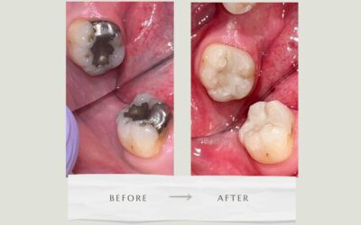 Is It Time to Remove Your Amalgam Fillings?