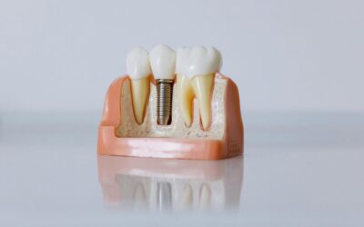 Zirconia Implants vs. Titanium Implants: What’s the Difference?