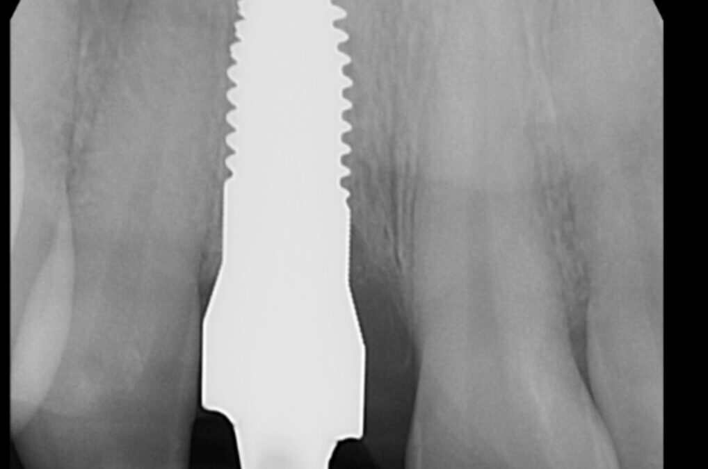 A Holistic Approach to Implant Healing: Integrating PRF, Ozone, and Laser Therapy