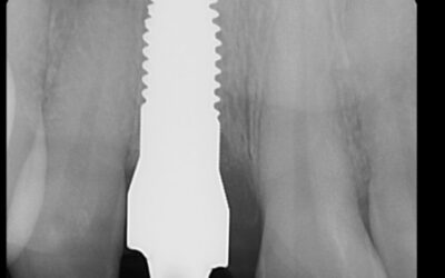 A Holistic Approach to Implant Healing: Integrating PRF, Ozone, and Laser Therapy