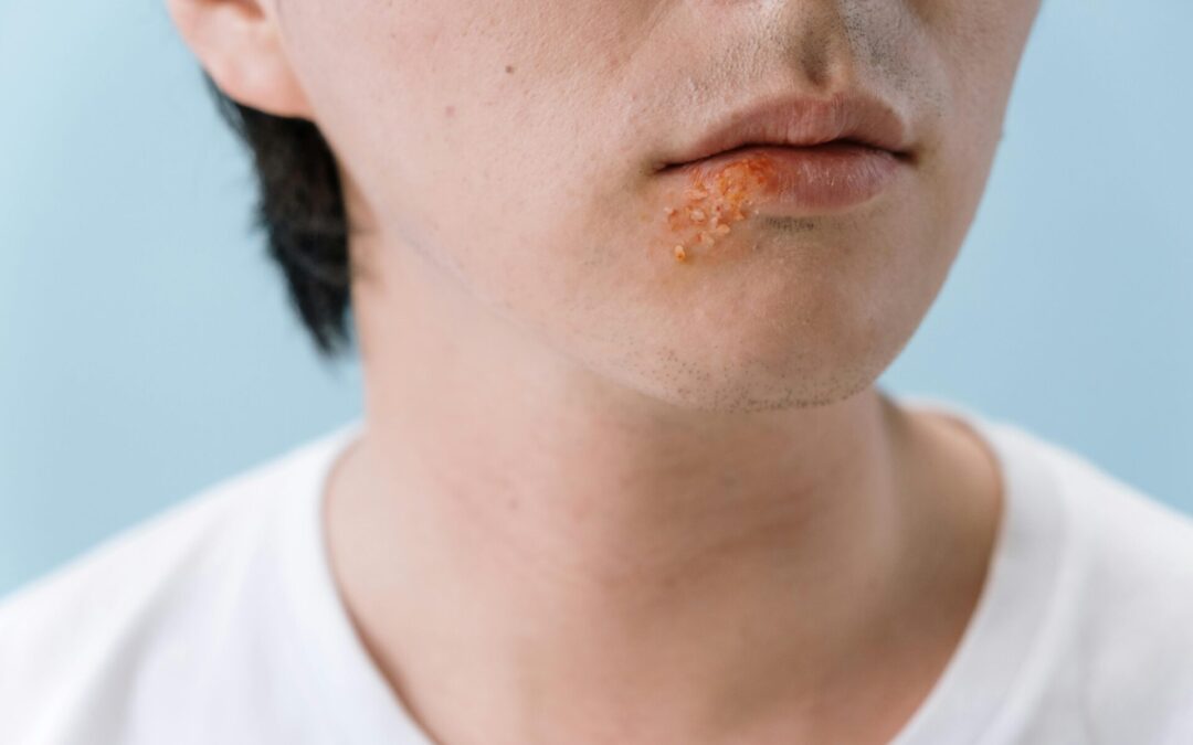 Did You Know Your Dentist Can Help Reduce Cold Sores with Laser Therapy?