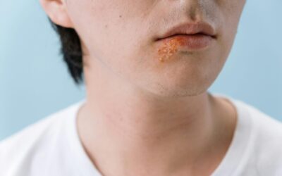 Did You Know Your Dentist Can Help Reduce Cold Sores with Laser Therapy?