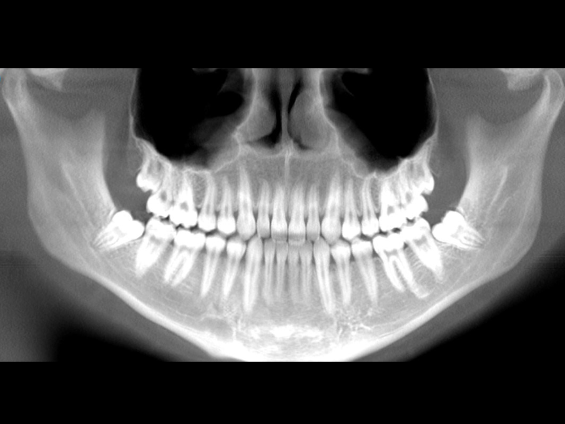 wisdom teeth