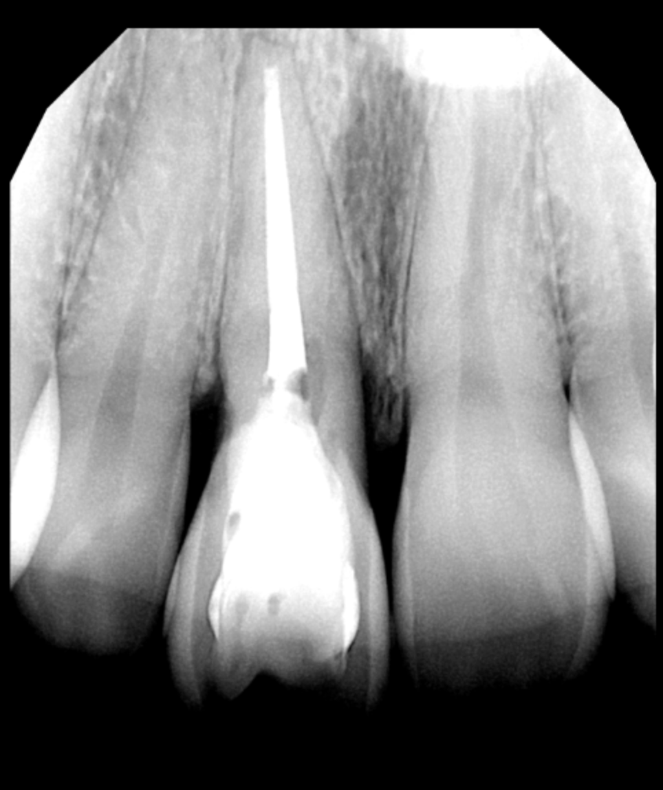 root canal removal