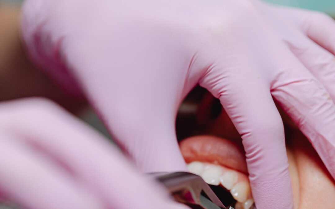 What Are Your Options After You Have to Get a Tooth Extracted?