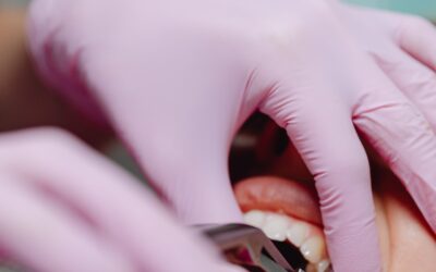 What Are Your Options After You Have to Get a Tooth Extracted?