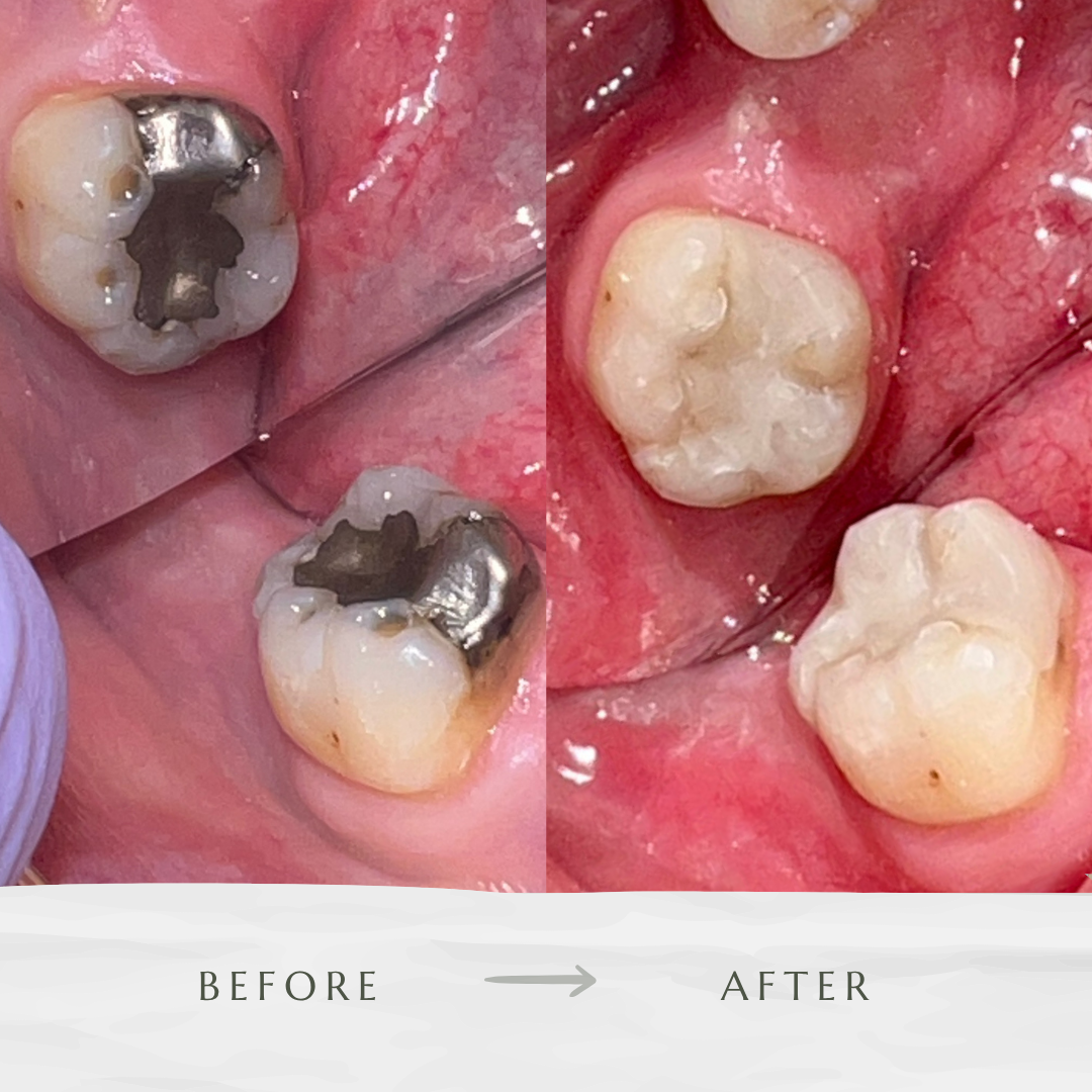 Safe Amalgam Removal