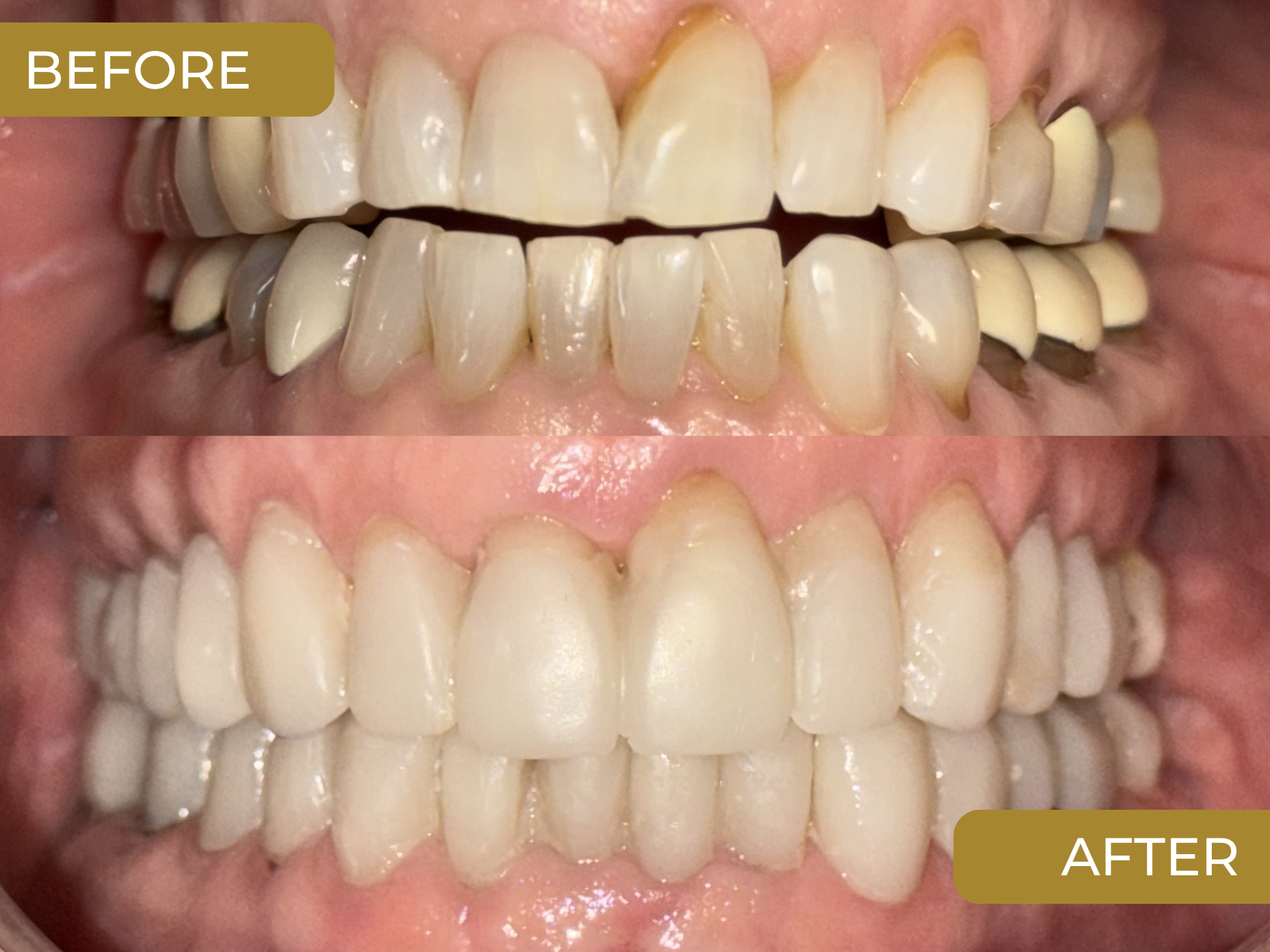 Full Mouth Rehabilitation & Restoration