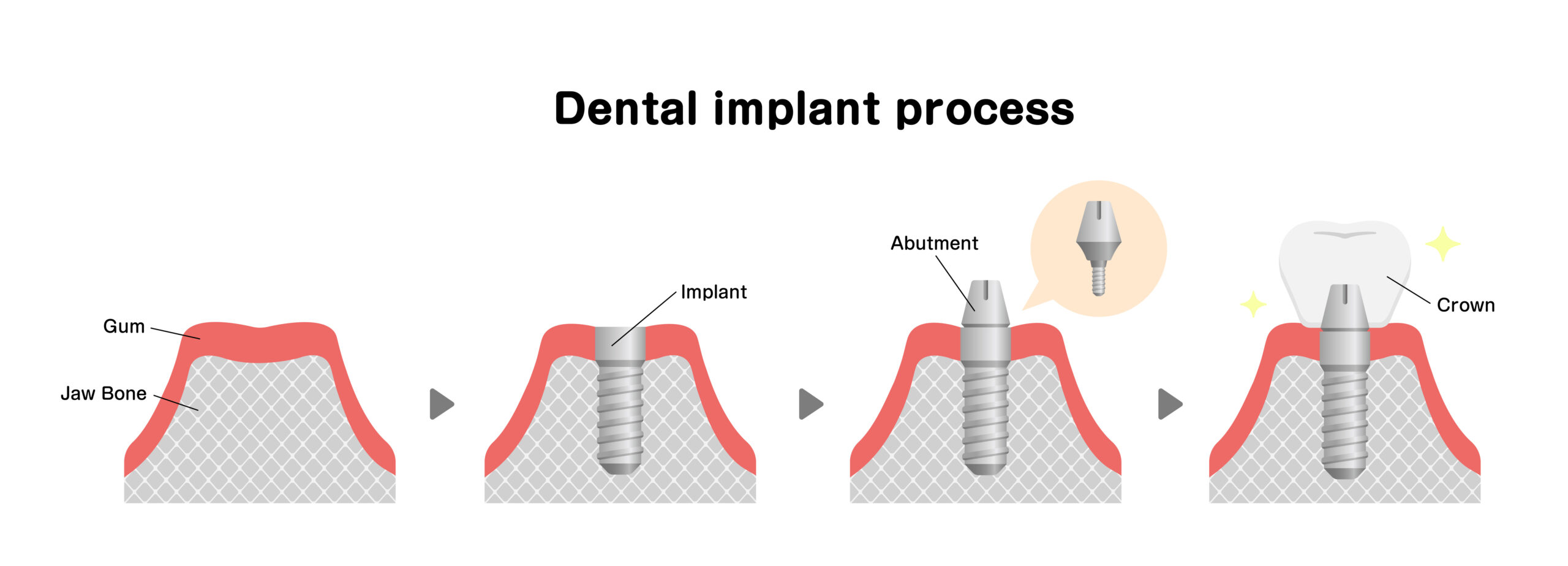 The Full Journey: What to Expect From Your First Implant Consultation to Final Teeth